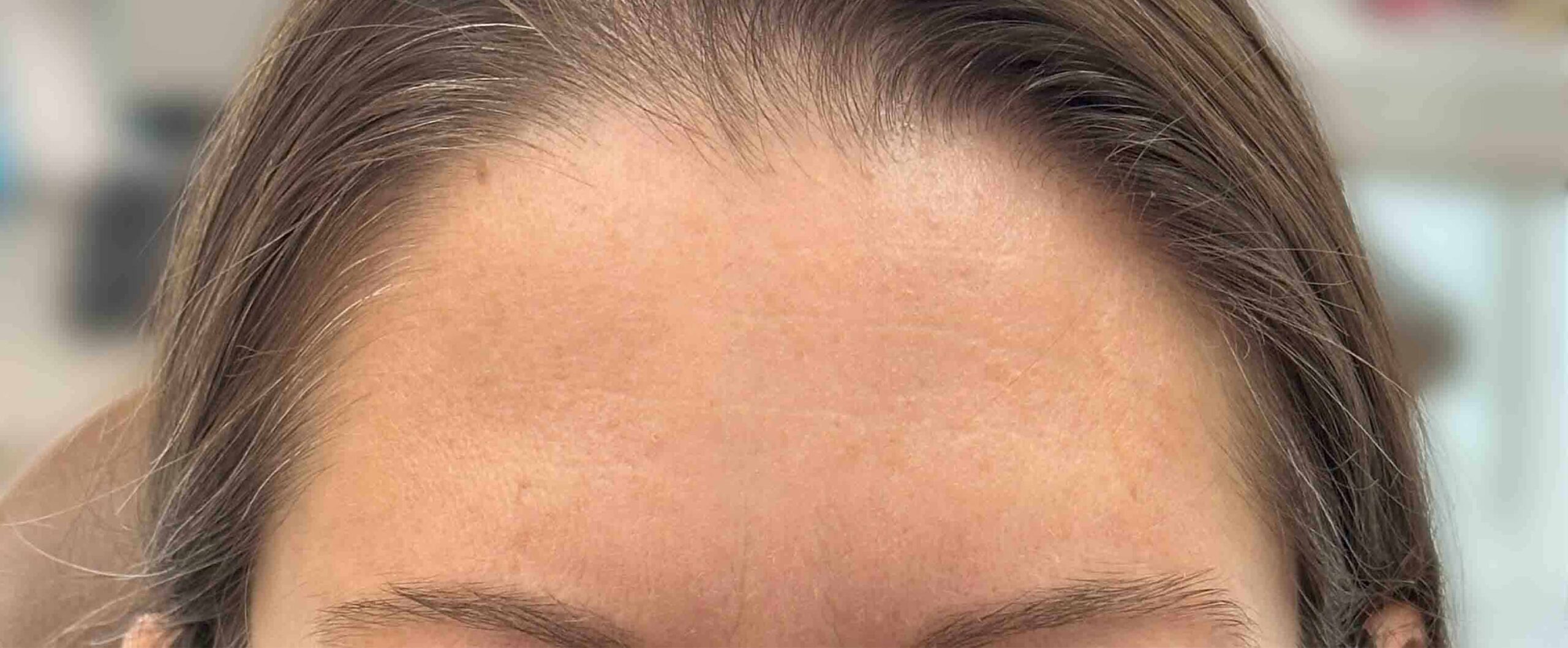 dental botox