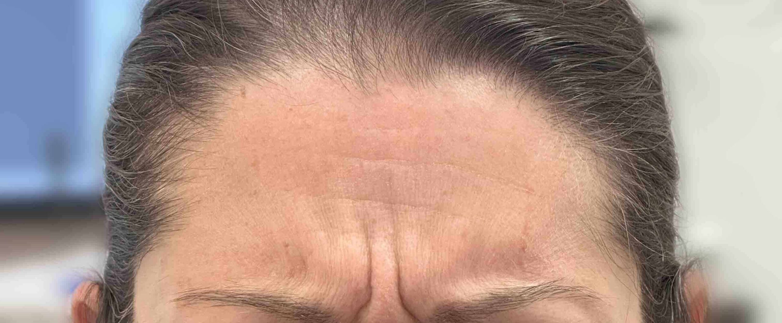 dental botox