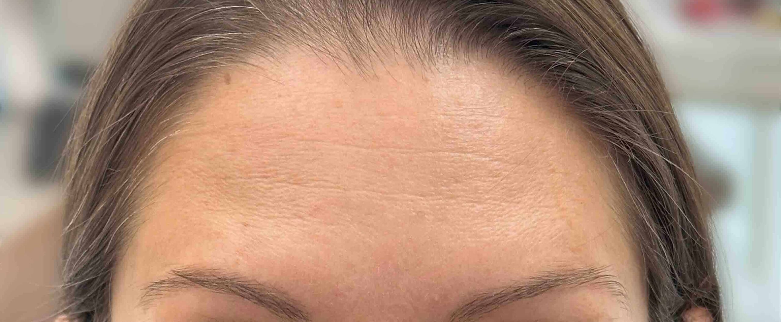 dental botox