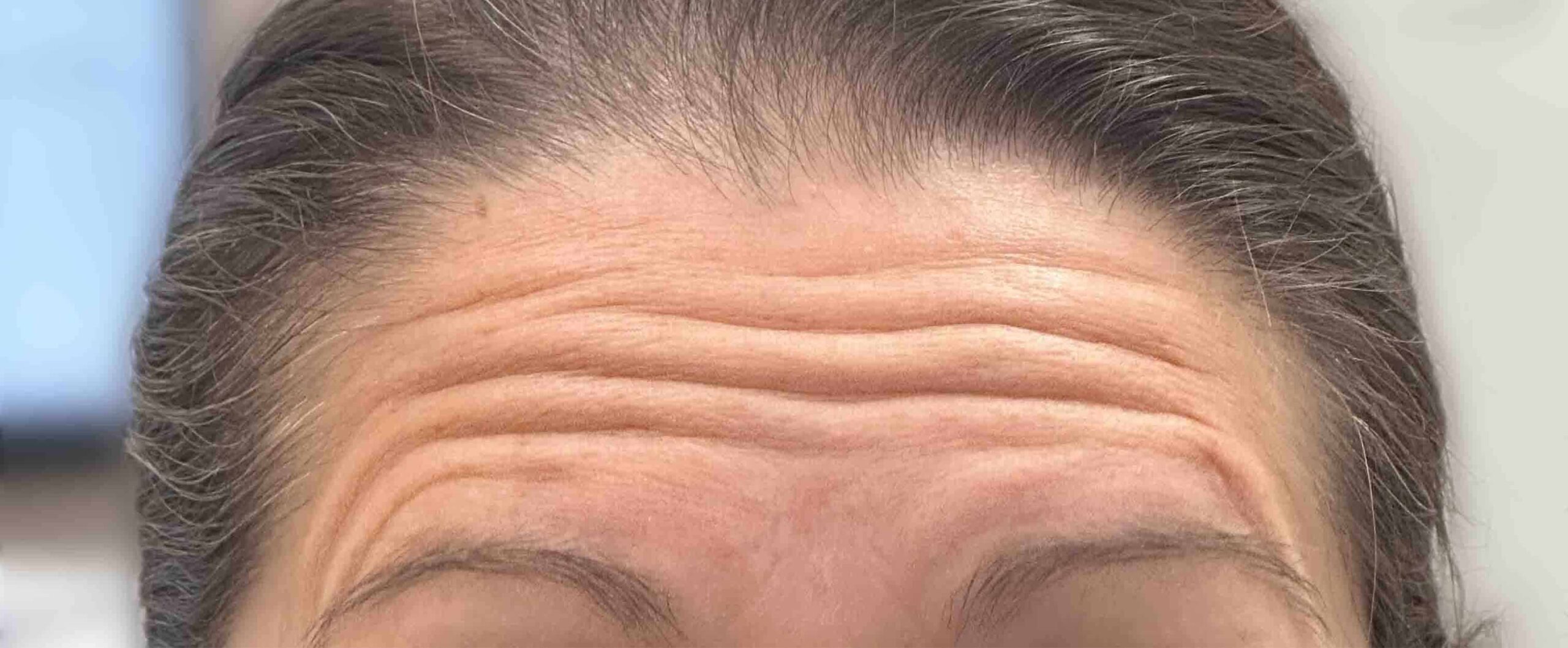 dental botox