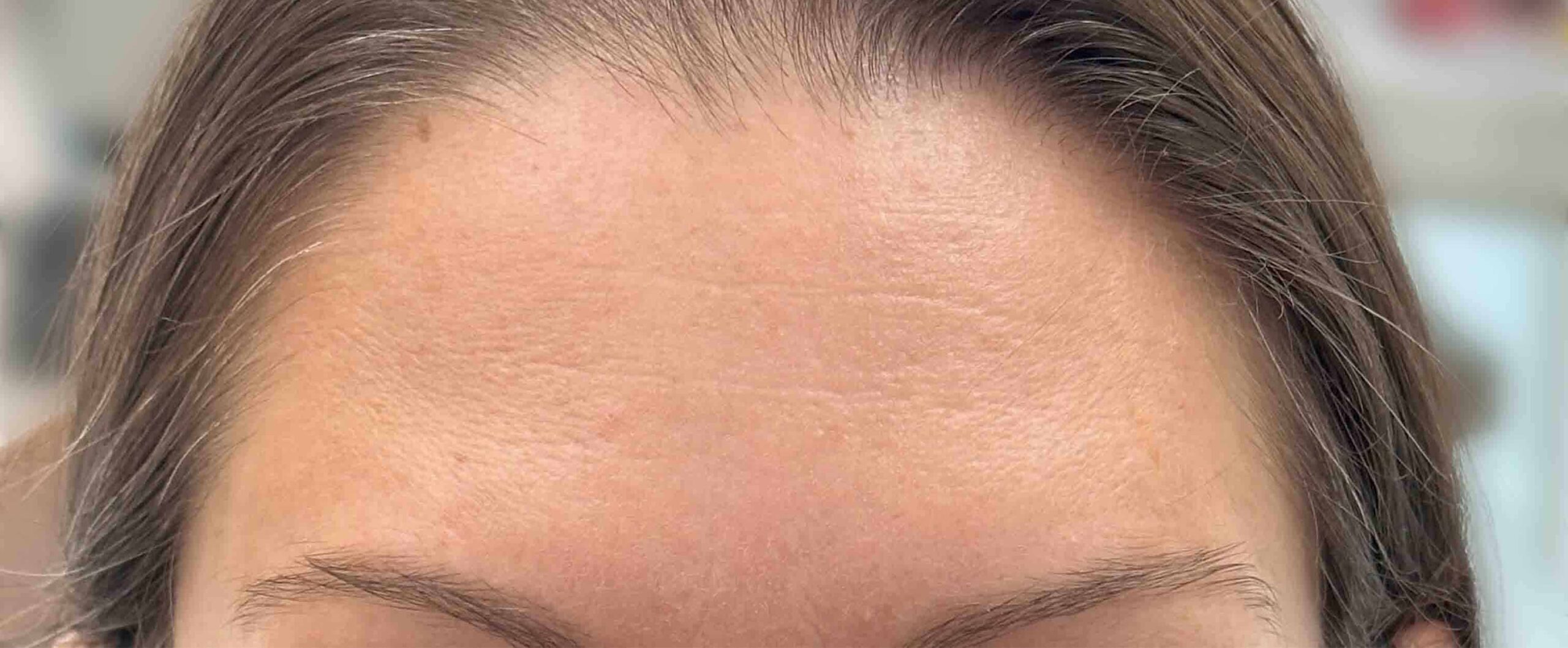 dental botox